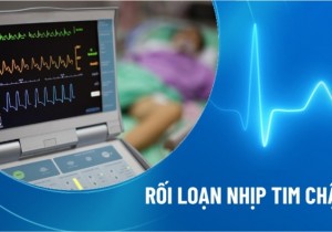 Rối Loạn Nhịp Chậm